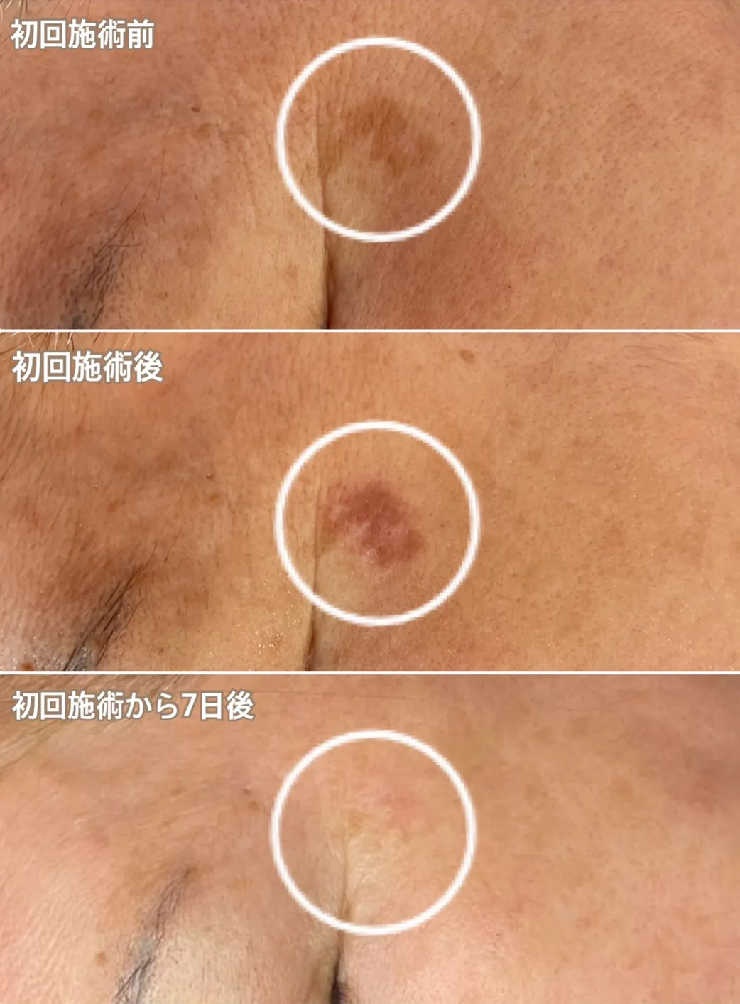 シミケアのビフォーアフター